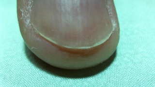 爪ヤスリによる処理